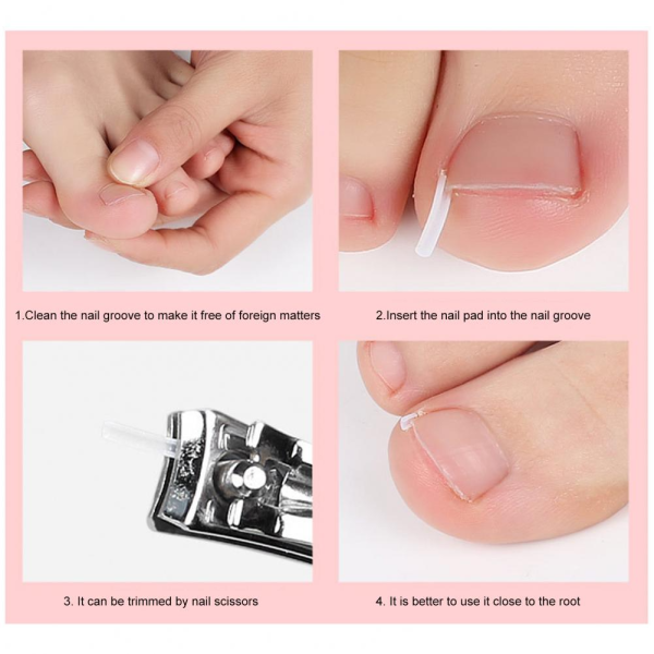 Toe Nail Support Pad