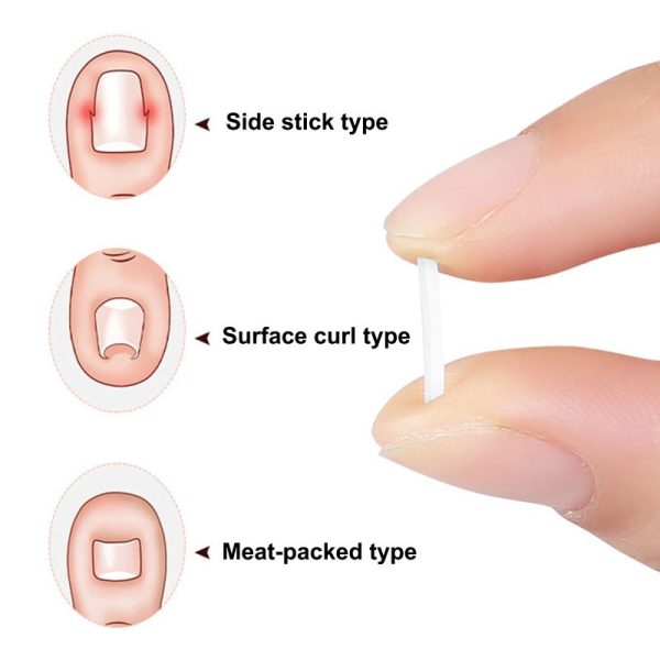 Toe Nail Support Pad